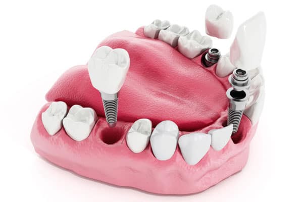 Dental Implants | Kitchener Dentist | Boeriu Implant Dentistry
