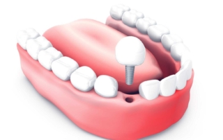 What is a dental implant?