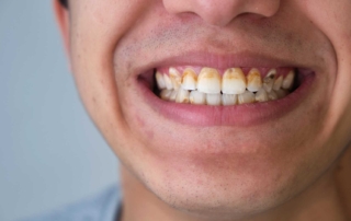 Tips to fighting off plaque and tartar
